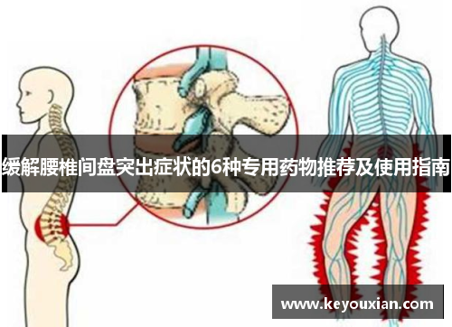 缓解腰椎间盘突出症状的6种专用药物推荐及使用指南